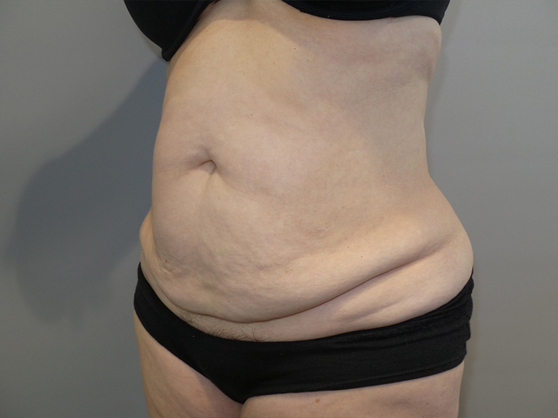 Tummy Tuck Before and After 116 | Sanjay Grover MD FACS