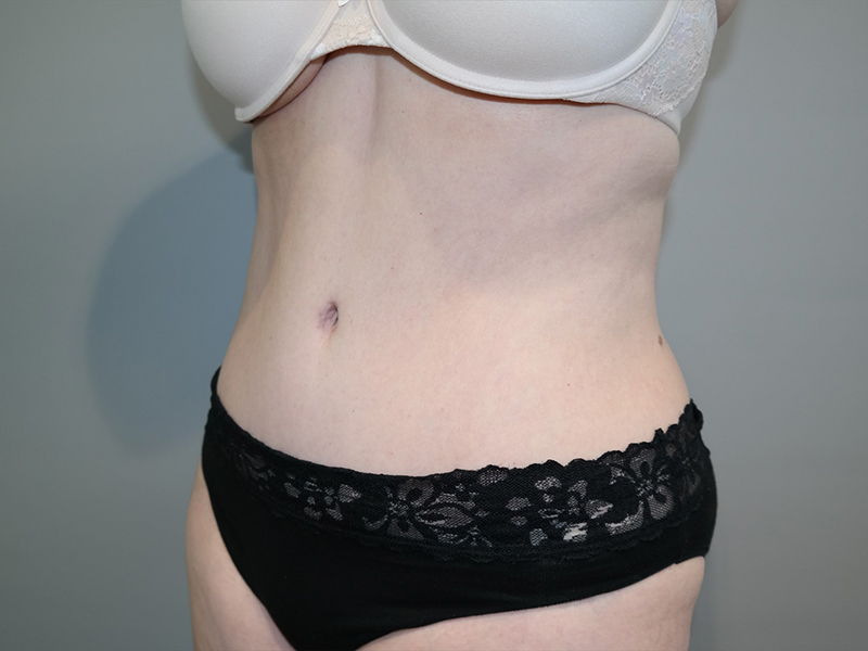 Tummy Tuck Before and After 116 | Sanjay Grover MD FACS