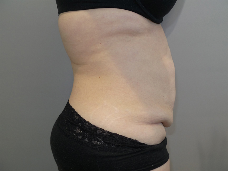 Tummy Tuck Before and After 116 | Sanjay Grover MD FACS