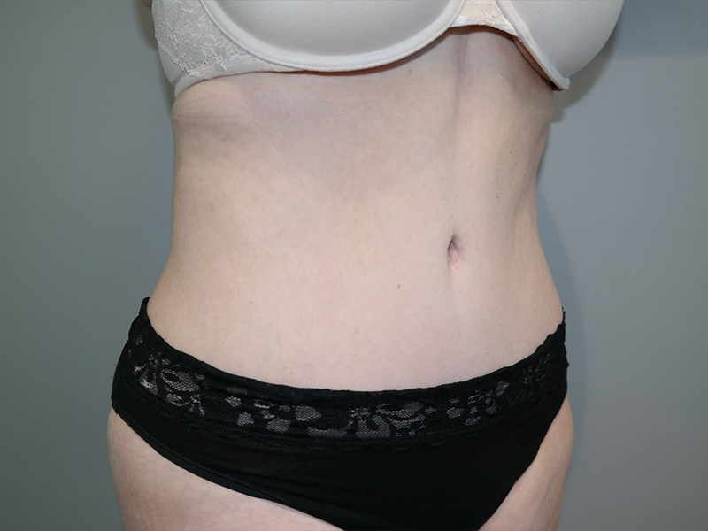 Tummy Tuck Before and After 116 | Sanjay Grover MD FACS