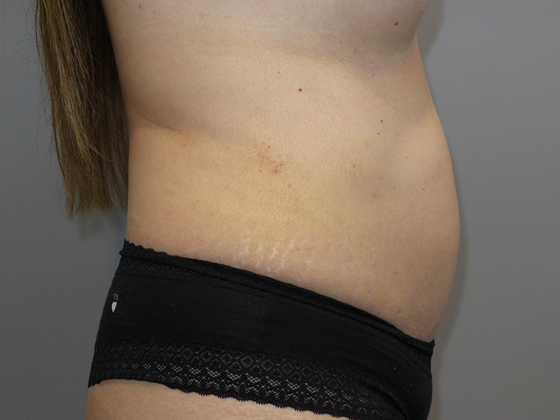 Tummy Tuck Before and After 117 | Sanjay Grover MD FACS