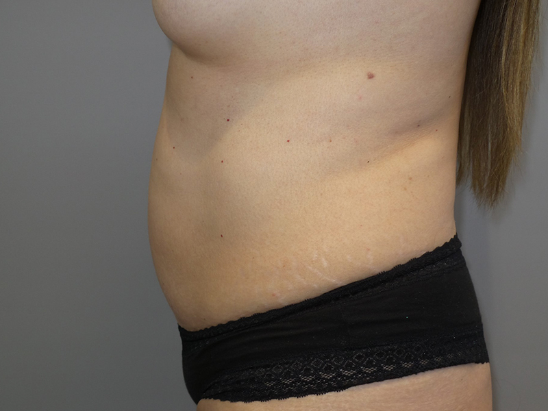 Tummy Tuck Before and After 117 | Sanjay Grover MD FACS