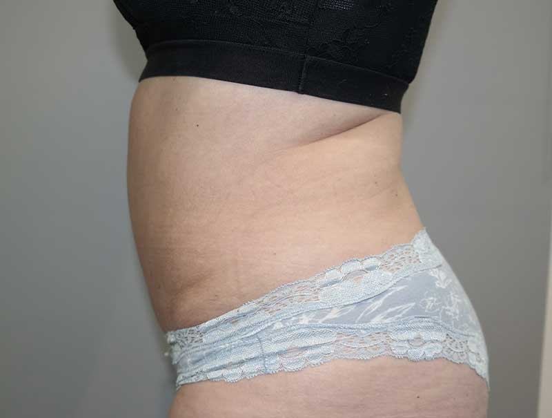 Tummy Tuck Before and After 12 | Sanjay Grover MD FACS