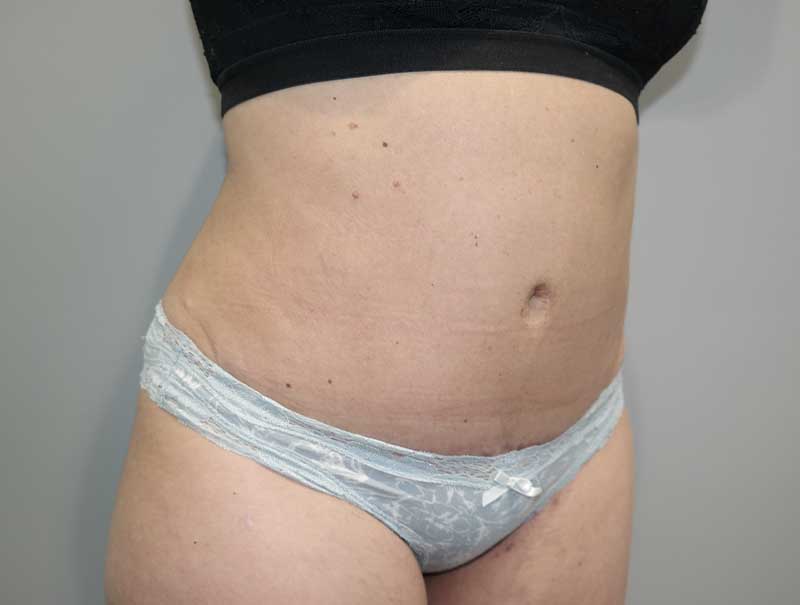 Tummy Tuck Before and After 12 | Sanjay Grover MD FACS