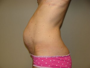 Tummy Tuck Before and After 14 | Sanjay Grover MD FACS