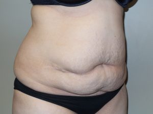 Tummy Tuck Before and After 15 | Sanjay Grover MD FACS