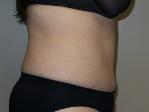 Tummy Tuck Before and After 15 | Sanjay Grover MD FACS