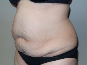 Tummy Tuck Before and After 15 | Sanjay Grover MD FACS