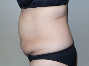 Tummy Tuck Before and After 15 | Sanjay Grover MD FACS