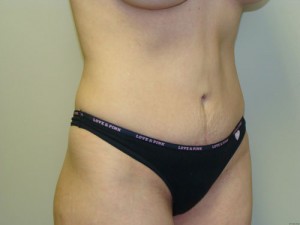 Tummy Tuck Before and After 16 | Sanjay Grover MD FACS