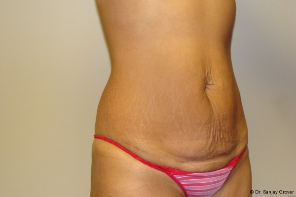 Tummy Tuck Before and After 17 | Sanjay Grover MD FACS