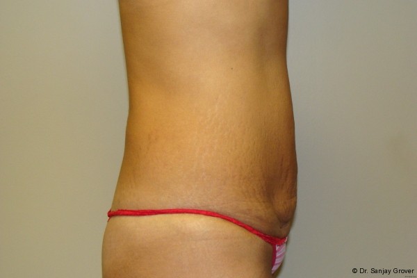 Tummy Tuck Before and After 17 | Sanjay Grover MD FACS