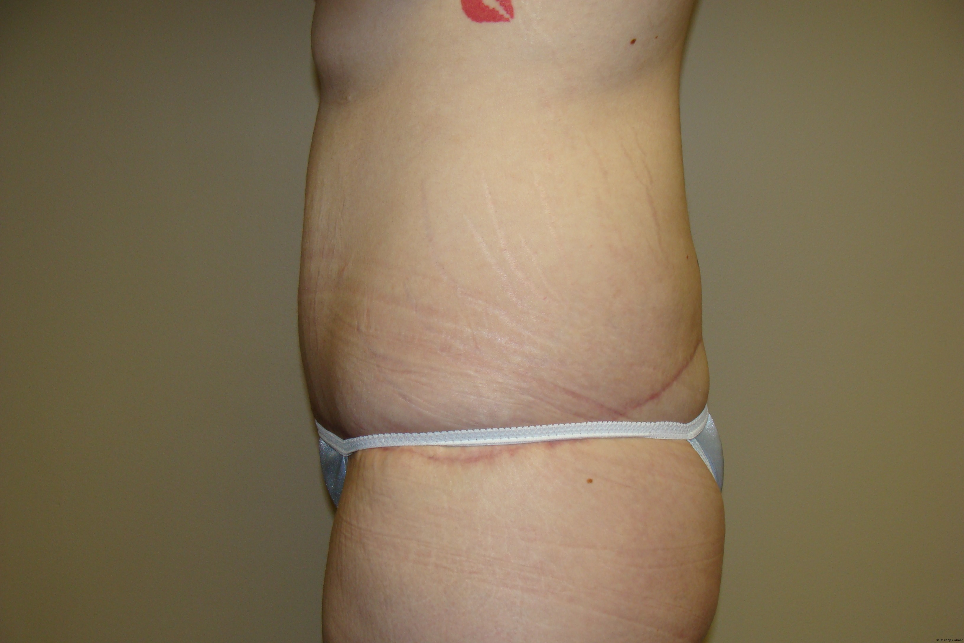 Tummy Tuck Before and After 18 | Sanjay Grover MD FACS