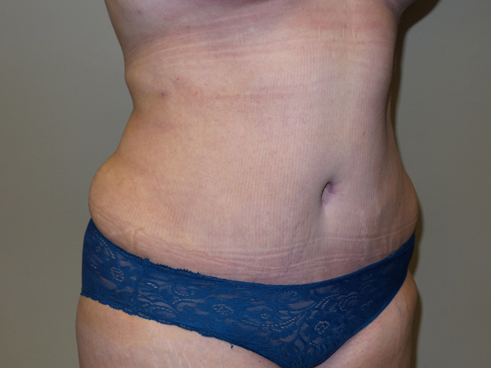 Tummy Tuck Before and After 19 | Sanjay Grover MD FACS