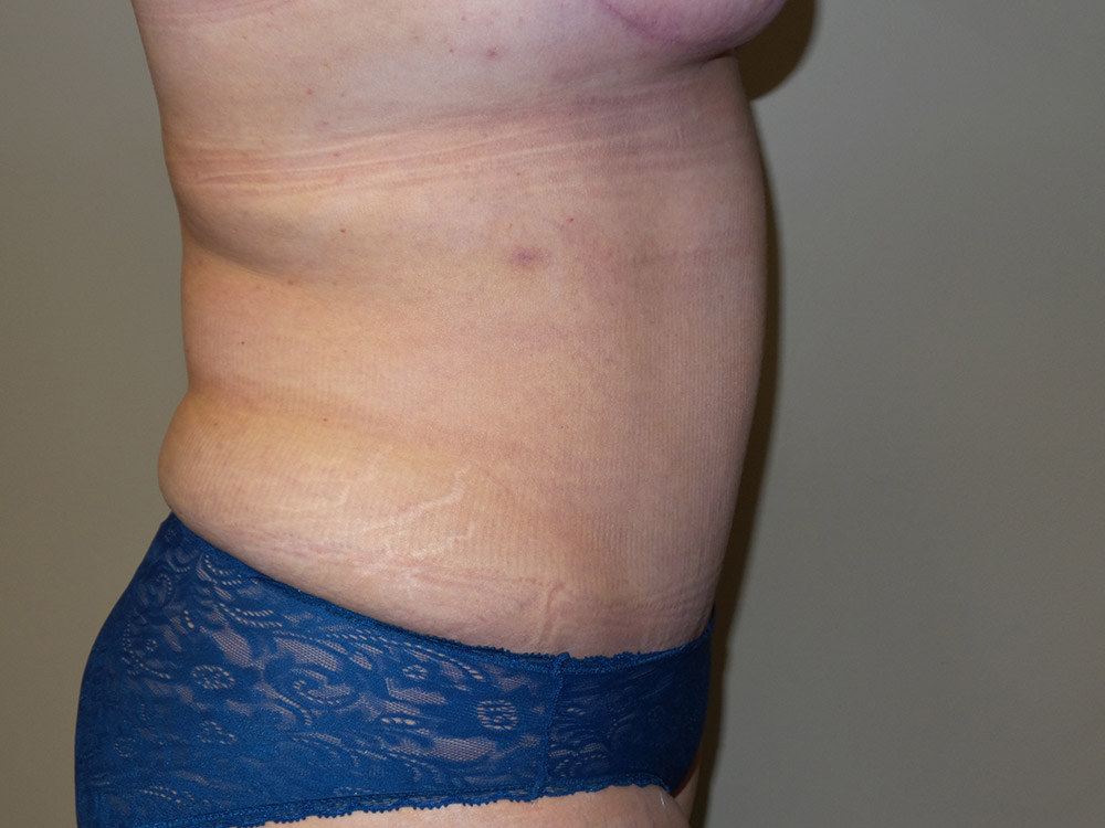 Tummy Tuck Before and After 19 | Sanjay Grover MD FACS