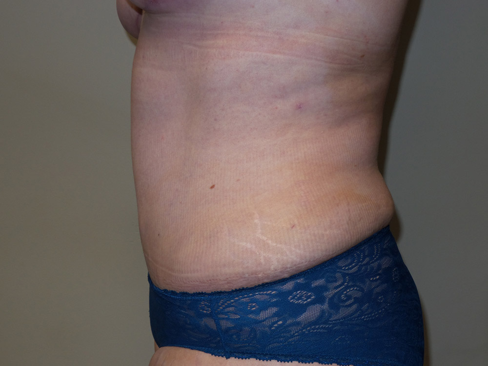 Tummy Tuck Before and After 19 | Sanjay Grover MD FACS