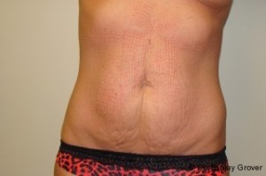 Tummy Tuck Before and After 115 | Sanjay Grover MD FACS