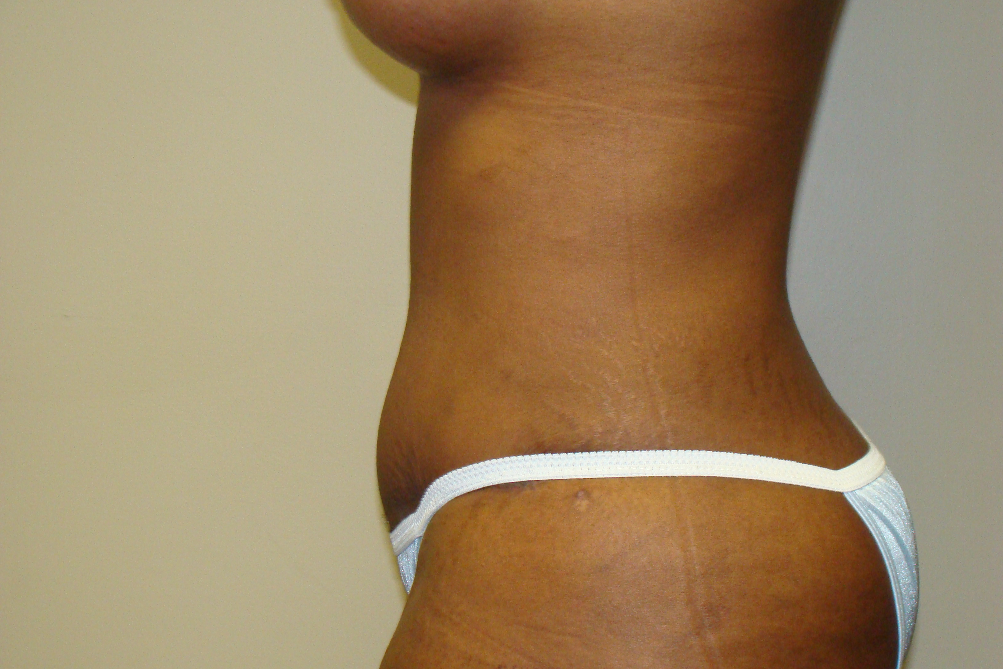 Tummy Tuck Before and After 21 | Sanjay Grover MD FACS