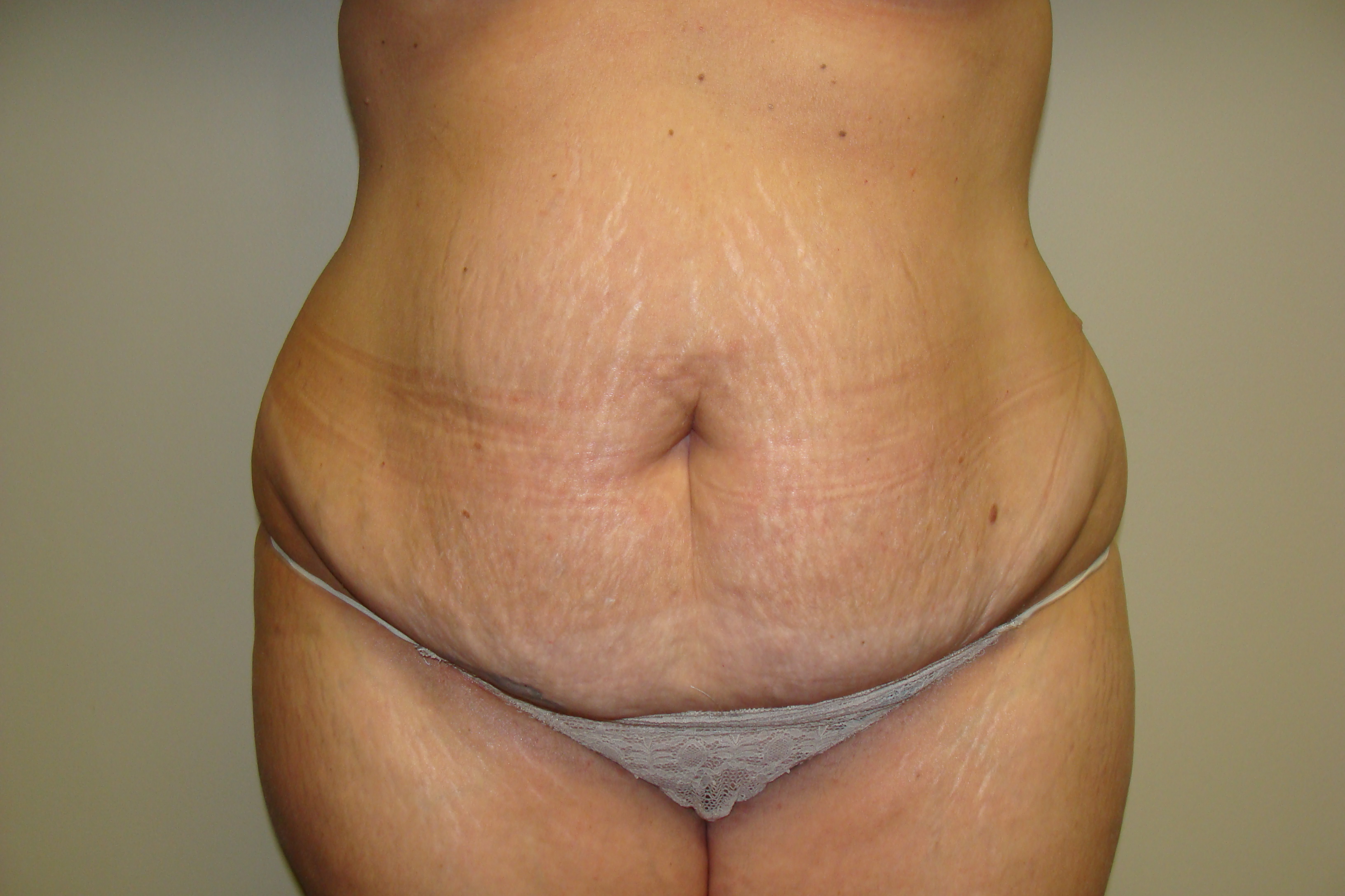 Tummy Tuck Before and After 54 | Sanjay Grover MD FACS