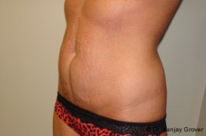 Tummy Tuck Before and After 22 | Sanjay Grover MD FACS