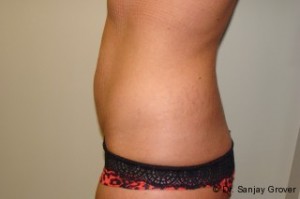 Tummy Tuck Before and After 22 | Sanjay Grover MD FACS