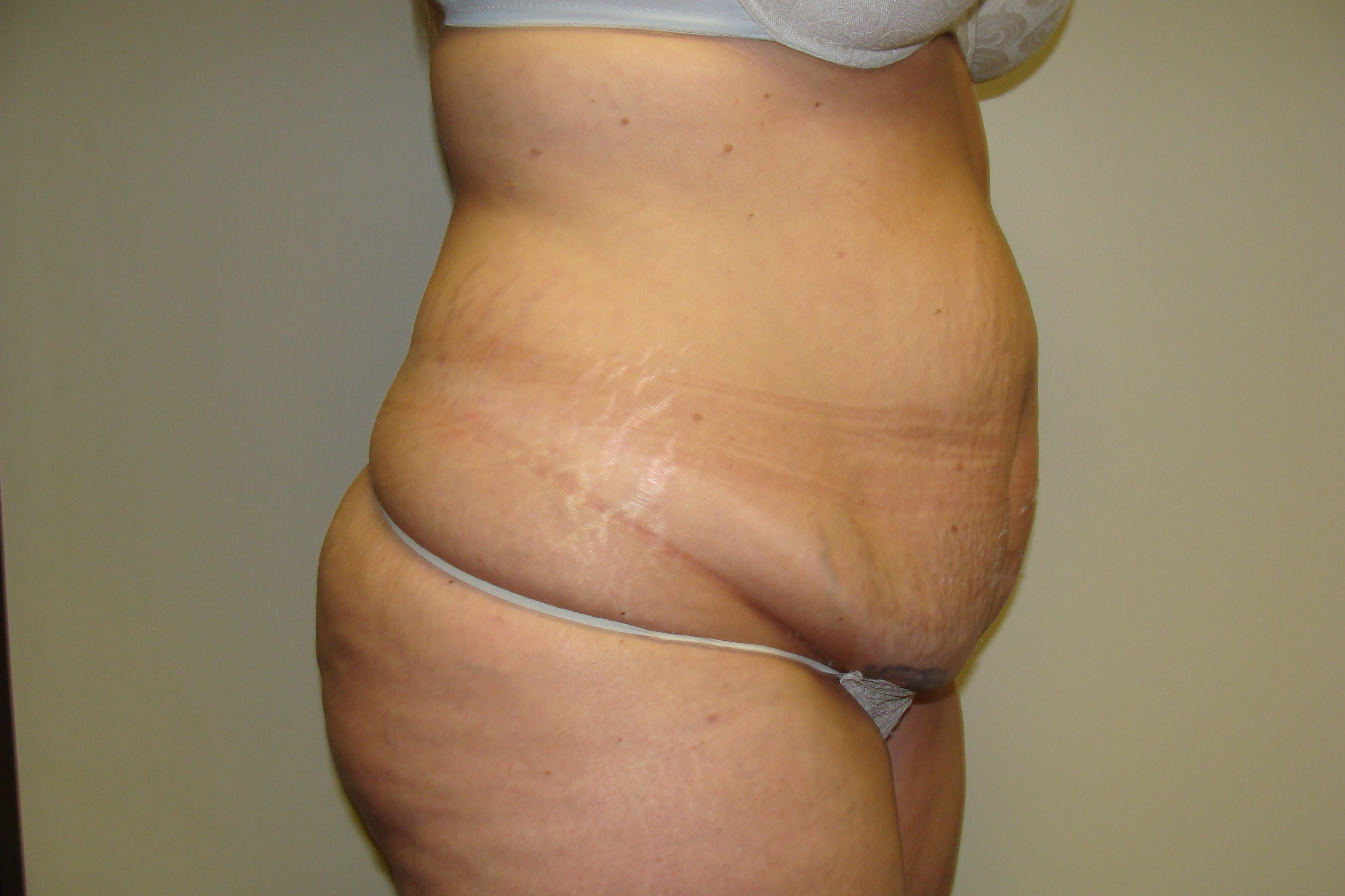 Tummy Tuck Before and After 23 | Sanjay Grover MD FACS