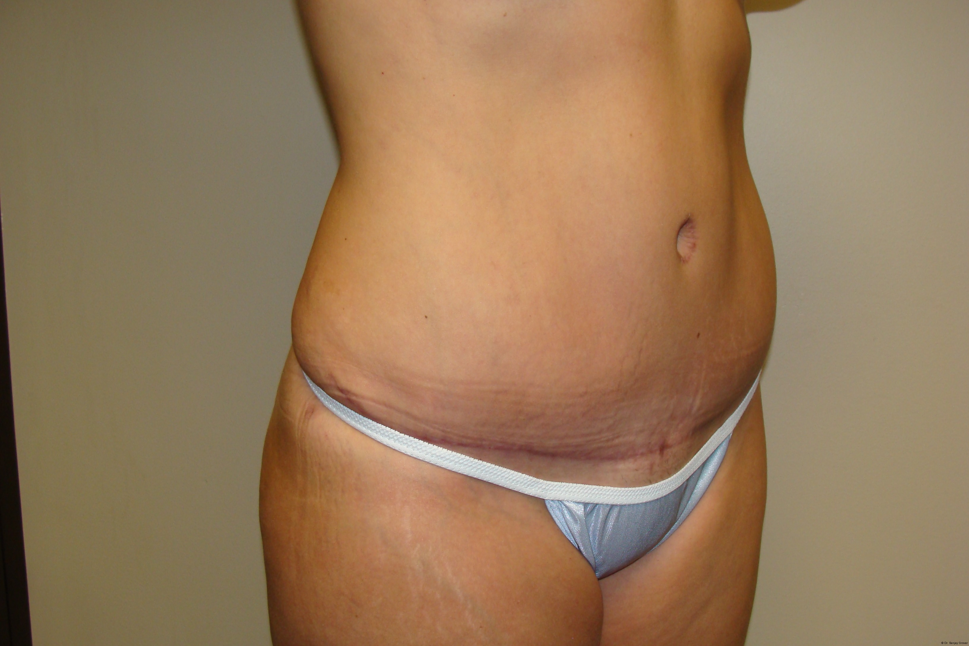 Tummy Tuck Before and After 24 | Sanjay Grover MD FACS