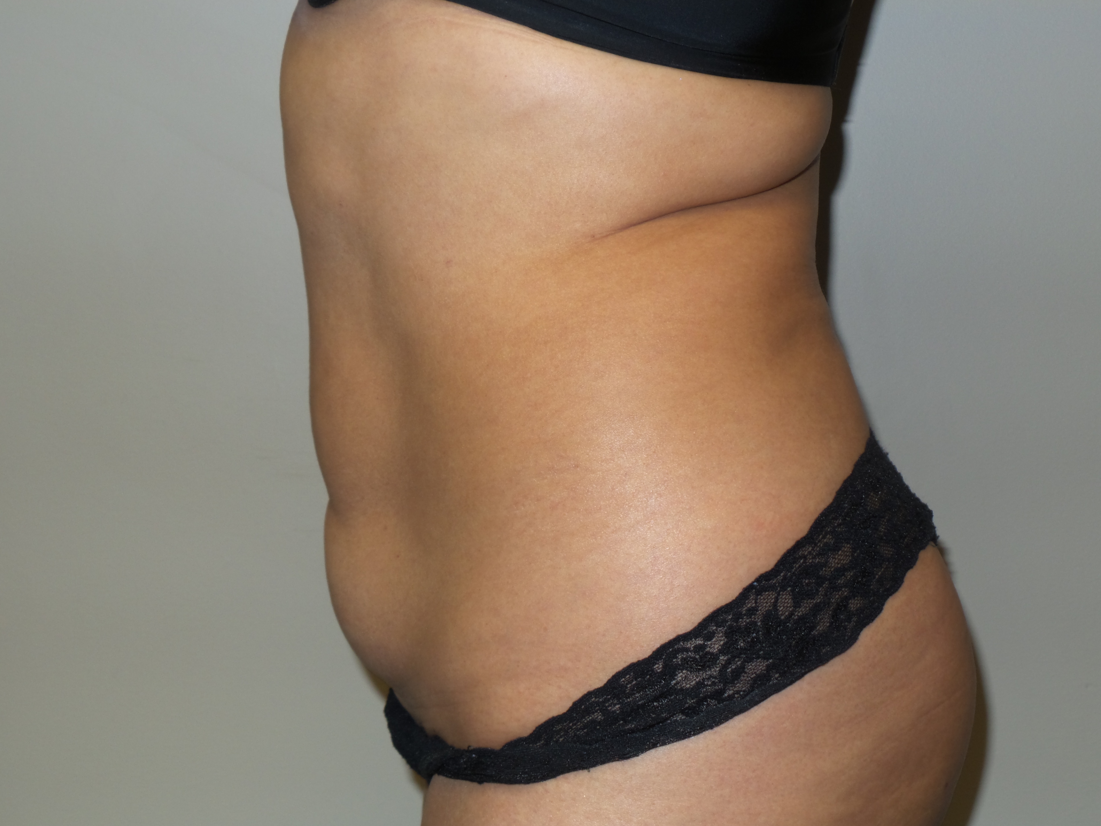 Tummy Tuck Before and After 25 | Sanjay Grover MD FACS