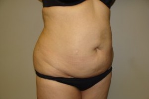 Tummy Tuck Before and After 26 | Sanjay Grover MD FACS