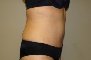 Tummy Tuck Before and After 26 | Sanjay Grover MD FACS