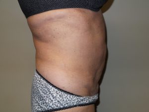 Tummy Tuck Before and After 27 | Sanjay Grover MD FACS