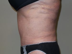 Tummy Tuck Before and After 27 | Sanjay Grover MD FACS