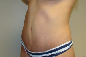 Tummy Tuck Before and After 28 | Sanjay Grover MD FACS