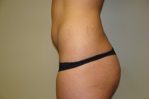 Tummy Tuck Before and After 28 | Sanjay Grover MD FACS