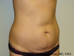 Tummy Tuck Before and After 31 | Sanjay Grover MD FACS