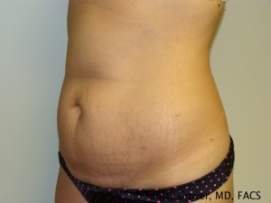 Tummy Tuck Before and After 31 | Sanjay Grover MD FACS