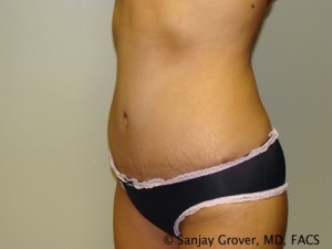 Tummy Tuck Before and After 31 | Sanjay Grover MD FACS