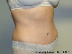 Tummy Tuck Before and After 33 | Sanjay Grover MD FACS