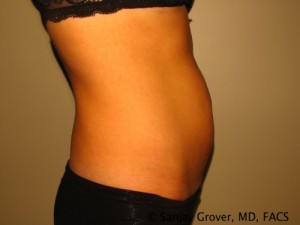 Tummy Tuck Before and After 33 | Sanjay Grover MD FACS