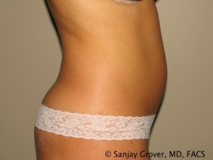 Tummy Tuck Before and After 34 | Sanjay Grover MD FACS