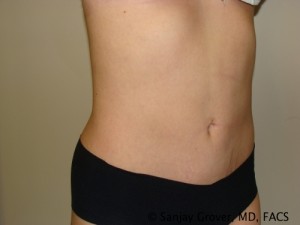 Tummy Tuck Before and After 35 | Sanjay Grover MD FACS