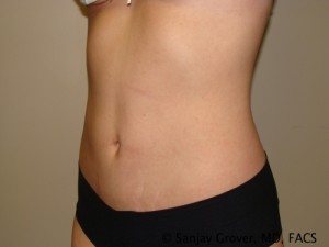 Tummy Tuck Before and After 35 | Sanjay Grover MD FACS