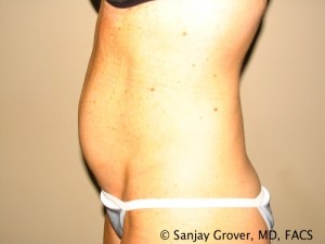 Tummy Tuck Before and After 36 | Sanjay Grover MD FACS