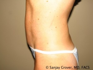 Tummy Tuck Before and After 36 | Sanjay Grover MD FACS