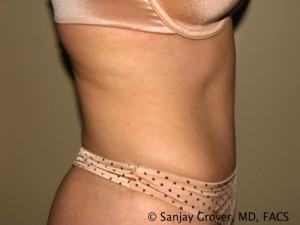 Tummy Tuck Before and After 37 | Sanjay Grover MD FACS