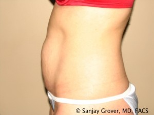 Tummy Tuck Before and After 37 | Sanjay Grover MD FACS