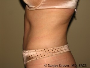 Tummy Tuck Before and After 37 | Sanjay Grover MD FACS