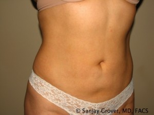 Tummy Tuck Before and After 38 | Sanjay Grover MD FACS