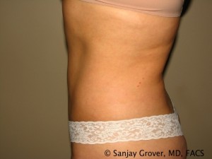 Tummy Tuck Before and After 38 | Sanjay Grover MD FACS