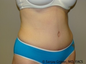 Tummy Tuck Before and After 39 | Sanjay Grover MD FACS